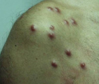 Псевдолимфомы кожи
