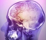 История болезни цвб хроническая ишемия головного мозга по неврология thumbnail