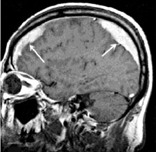 Субдуральная гематома левой гемисферы головного мозга thumbnail