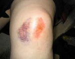 Ушиб коленного сустава человека thumbnail