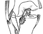 Ортез при переломе мыщелка большой берцовой кости thumbnail