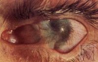 Симптомы при ожоге слизистой глаза thumbnail