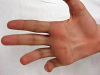 Как лечить ушиб нерва руки thumbnail