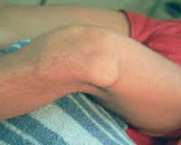 Вывих голени коленного сустава thumbnail