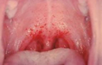 Источником инфекции при геморрагической лихорадке с почечным синдромом thumbnail