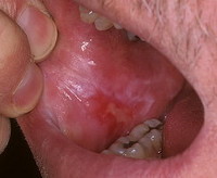Ожог слизистой рта аммиаком лечение thumbnail