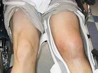Лечение ушиба коленного сустава thumbnail