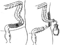 Операция гартмана при кишечной непроходимости