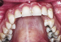 Вывихи и переломы зубов альвеолярного отростка thumbnail