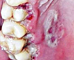 Язвенный некротический стоматит венсана вызванное симбиозом thumbnail