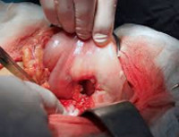 Лечение перитонита при прободной язве желудка thumbnail