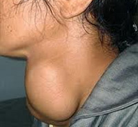 Лечение узлового зоба щитовидной железы у женщин thumbnail