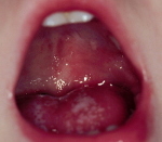 Лечение ожога в полости рта после лучевой thumbnail