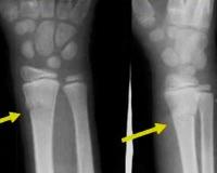 Перелом лучевой кости у детей в типичном месте фото thumbnail