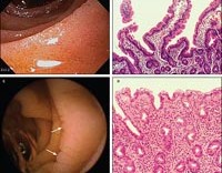Синдром мальабсорбции при болезни крона thumbnail