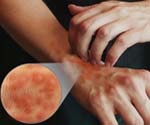 Что вызывает атопический дерматит в молодом возрасте thumbnail