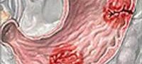 Что такое желудочно кишечное кровотечение язвенного генеза thumbnail