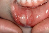Стоматит протекание у детей thumbnail