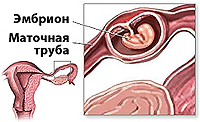 Внематочная беременность