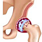 Лечение деформирующего коксартроза тазобедренного сустава thumbnail