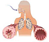 Что такое бронхиальная астма простыми словами thumbnail