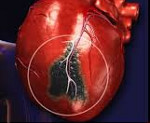 Инфаркт миокарда по отделам сердца thumbnail