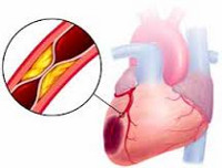 Причины симптомы лечение инфаркта миокарда thumbnail