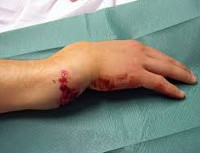 Перелом сустава рука лечение thumbnail