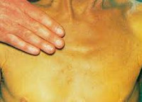 Хронический гепатит с холестатическим синдромом thumbnail