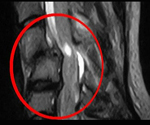 Открытые повреждения позвоночника и спинного мозга thumbnail