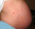 Краснуха симптомы у взрослых при беременности фото thumbnail