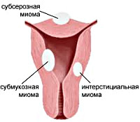 Интерстициальная миома матки симптомы и признаки thumbnail