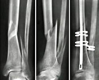 Берцовая кость ноги лечение переломов thumbnail