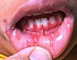 Герпетический стоматит у ребенка симптомы лечение thumbnail