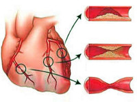 Ишемическая болезнь сердца классификация и лечение thumbnail
