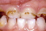 Диагностика и лечение гипоплазии зубов thumbnail
