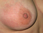 Лечение при ушибе женской груди thumbnail