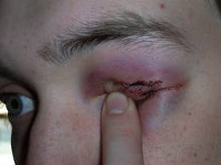 Повреждения органа зрения ранения контузии ожоги thumbnail