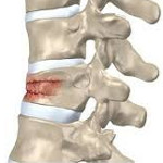 Картина компрессионного перелома тела позвоночника thumbnail