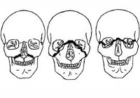 Переломы челюстей типы и признаки переломов thumbnail