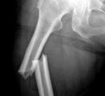 Клиническая картина при переломах бедренной кости thumbnail