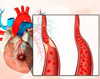 Ишемические болезни сердца инфаркт миокарда thumbnail