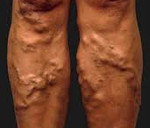 Клиники варикозное расширение вен на ногах симптомы thumbnail