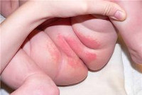 От чего возникает дерматит у детей thumbnail
