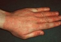 Контактный аллергический дерматит причина заболевания thumbnail