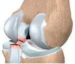Повреждения связок коленного сустава клиника диагностика лечение thumbnail