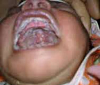 Осложнение при молочнице у ребенка thumbnail