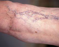 Варикозное расширение вен на ногах симптомы и лечение википедия thumbnail