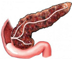 Лечение фиброза поджелудочной железы thumbnail