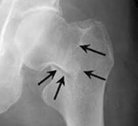 Около и внутрисуставные переломы костей верхней конечности thumbnail